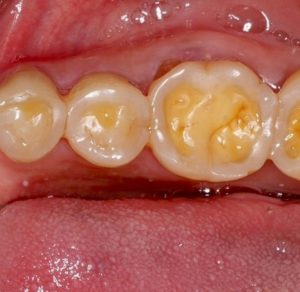 What is dental erosion? | McKeefry Dental