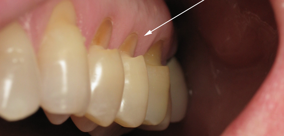 What is dental erosion? | McKeefry Dental