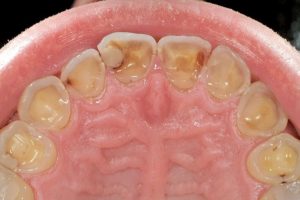 Dental Erosion