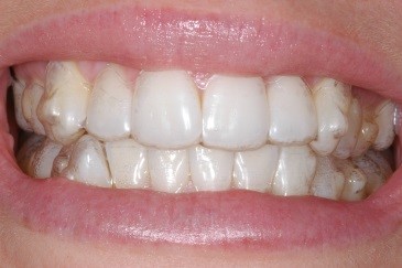 Invisalign