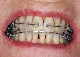 Teeth Straightening: Invisalign vs. Braces - McKeefry Dental